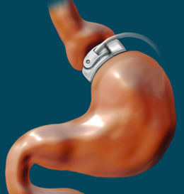 Hipnose para Banda Gastrica